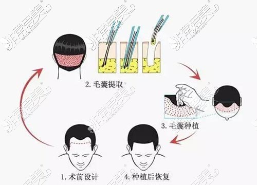 毛发移植手术技术示意图