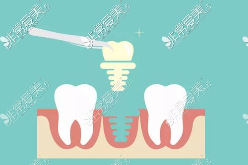 种植牙示意图