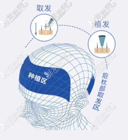 鄭州芳藝植發(fā)優(yōu)勢分析小面積試種