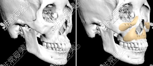 3D打印人工骨补骨