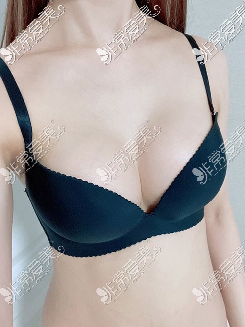 韩国U＆U整形外科隆胸图片