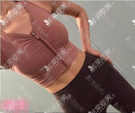 宁波Yestar艺星整形腰腹吸脂术后一个月照片