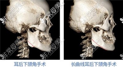 下颌角削骨术式解释