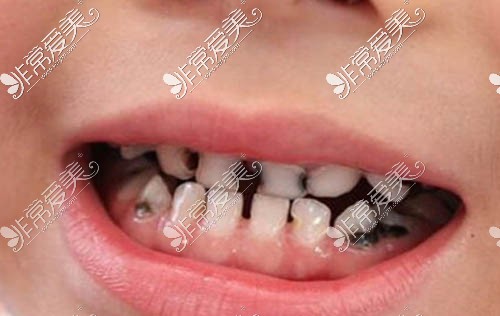 乳牙龋坏照片