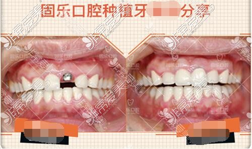 固乐口腔种植牙病例分享