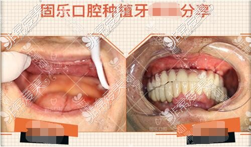 郑州固乐口腔医院全口种植牙真人前后对比图