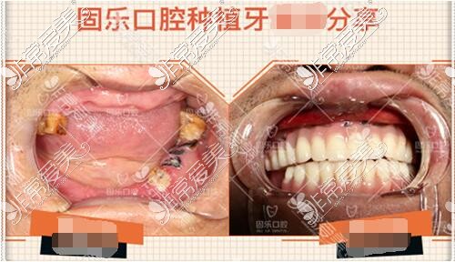 郑州固乐口腔种植牙疗效怎么样