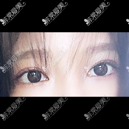 韩国icon整形医院双眼皮修复图