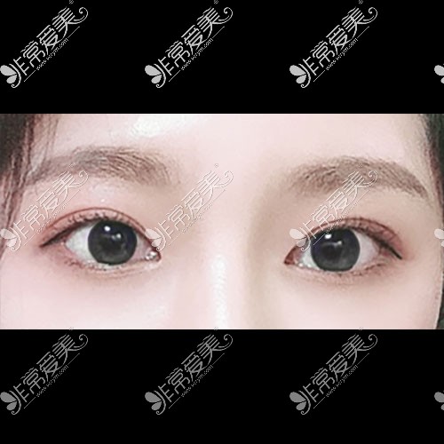 韩国icon整形医院双眼皮修复
