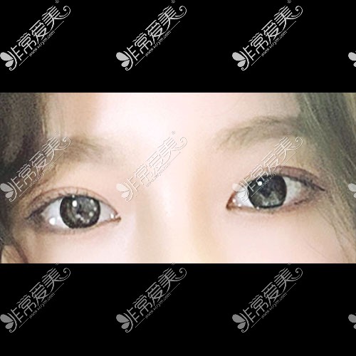 韩国icon整形医院双眼皮修复照片