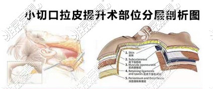 小切口拉皮提升部位分層剖析圖