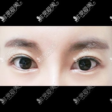 韩国icon双眼皮整形照片