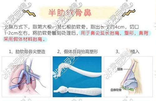 半肋隆鼻手术过程步骤