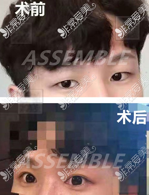 男士双眼皮手术照片