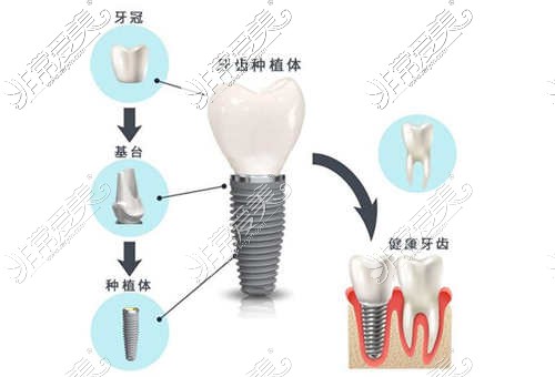 种植牙的组成部分