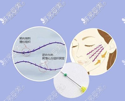 面部提升改善照片