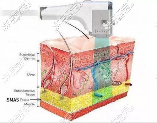 Fotona4D pro全层抗衰