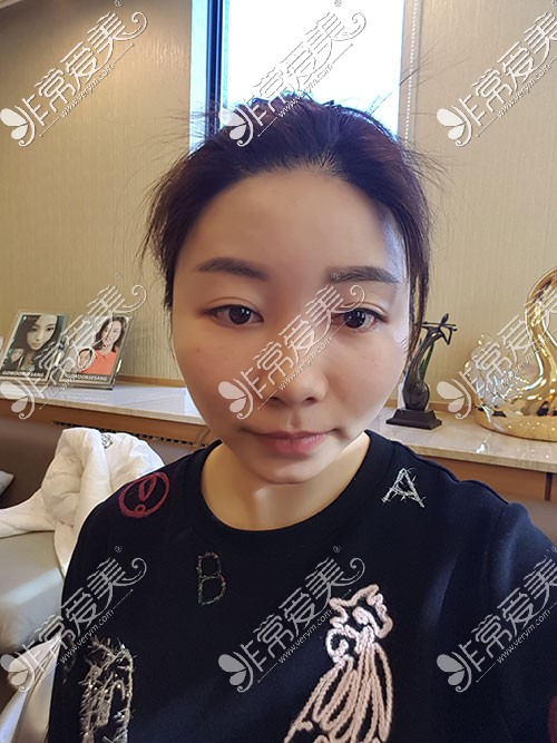 韩国德丽珍整形医院眼鼻术前照片