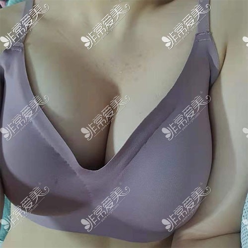 韩国格瑞丝噢爱美整形外科隆胸照片
