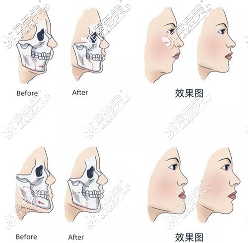 正颌卡通图照片