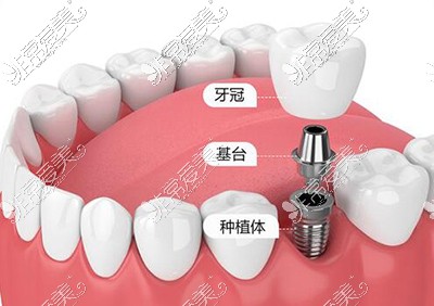 種植牙改善卡通圖照片