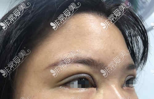 双眼皮手术后线条