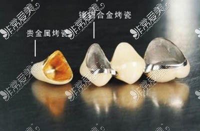 不同材料牙齿照片