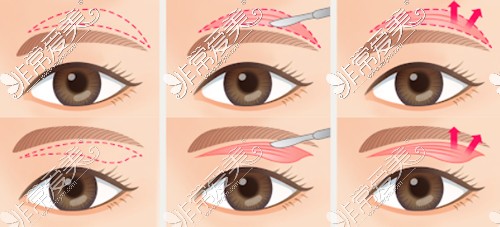 眉上切口和眉下切口术式对比