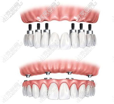 费用分享:广州满口种植牙大概多少钱,不同植体价格差有多少