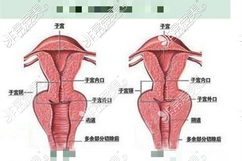 缩阴手术解决私处松弛问题