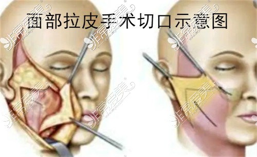 面部拉皮手术操作示意图