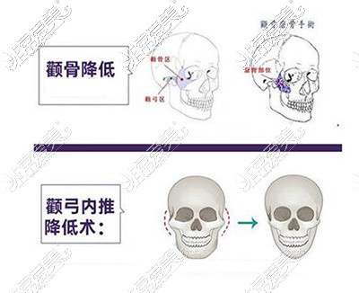 颧弓颧骨整形卡通图