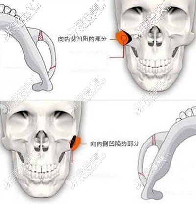 颧骨整形卡通示意图