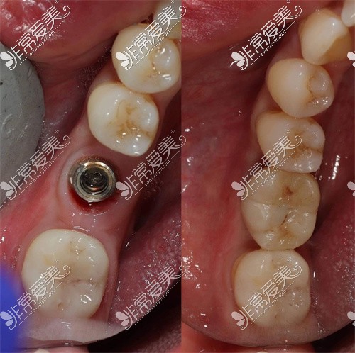 新都种植牙示意