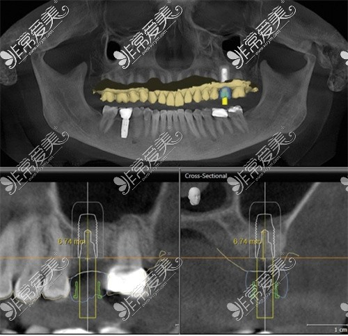 新都牙先森口腔种植牙CT