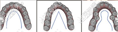 牙齿矫正各种情况