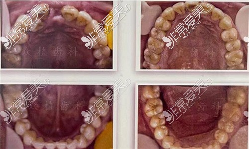 太原众植齿科牙齿矫正对比4