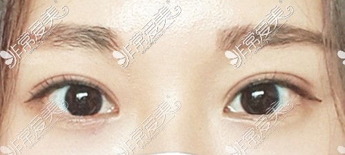 韩国icon整形眼部手术术后照片