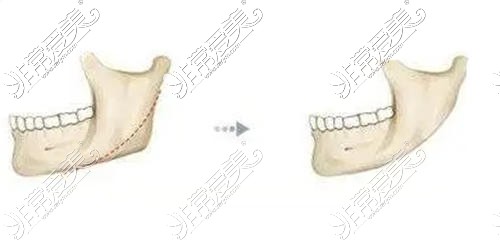 贵阳磨骨手术去哪家做好?下颌角磨骨多少钱价格高不高