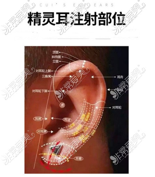 精靈耳注射部位