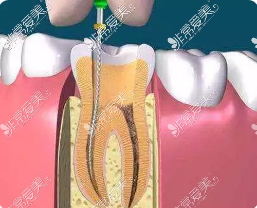 根管治疗示意图