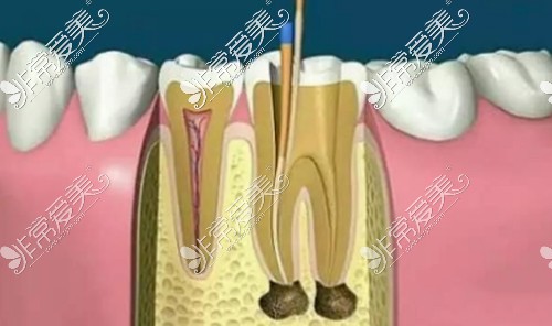 根管治疗示意图