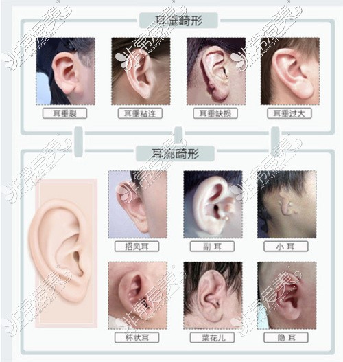耳朵畸形的几种表现