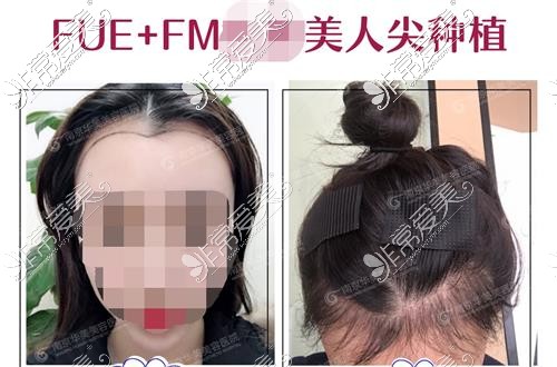 南京华美美容医院植美人尖示意图