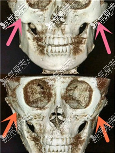 成都東籬整形醫(yī)院顴骨內(nèi)推CT