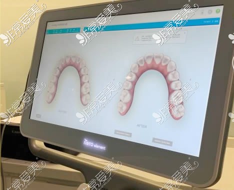 深圳弘和口腔牙齿矫正方案设计