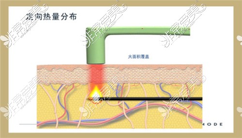 钻石精细雕刻吸脂术原理