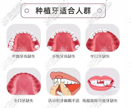 哪些牙齿需要做种植改善