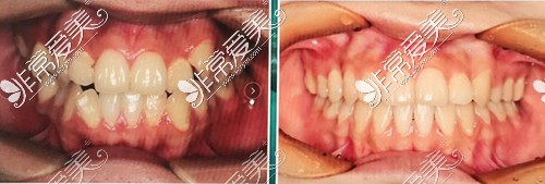 福州维乐口腔牙齿矫正前后