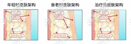 热玛吉治疗前后